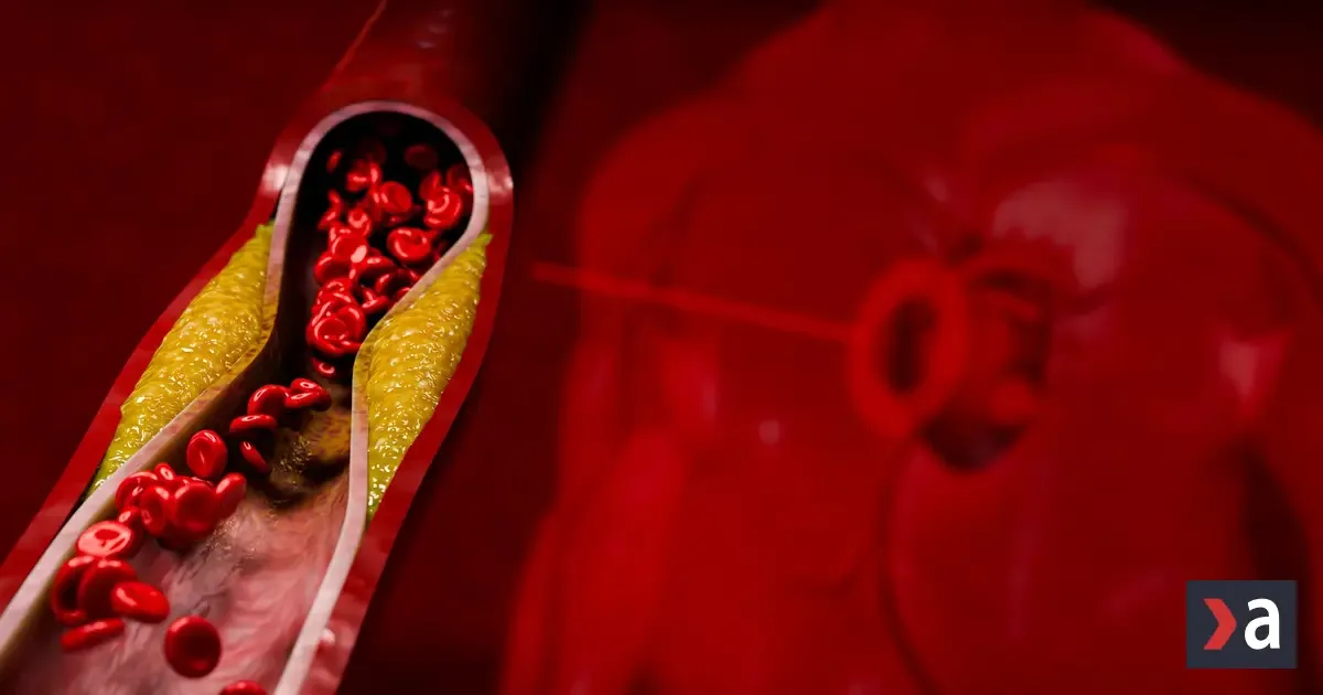 Tiché príznaky na koži, očiach a šľachách: Ako odhaliť vysoký cholesterol včas?